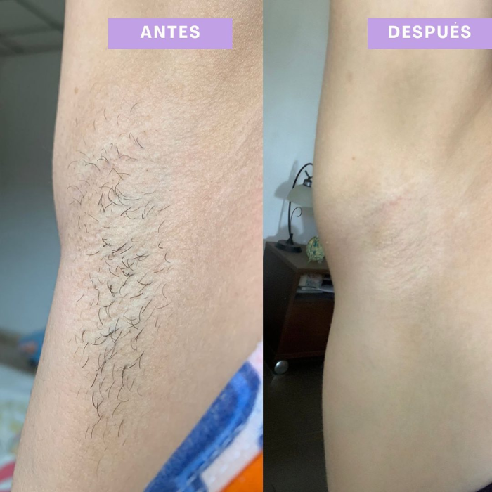 Resultado antes y despues